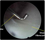 Advanced Wrist Arthroscopy