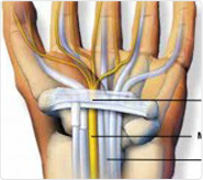 Endoscopic Carpal Tunnel Release (ECTR)
