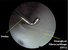 wrist-arthroscopy