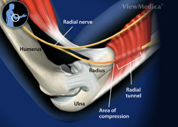 Radial Tunnel Syndrome Doctor Los Angeles, Radial Tunnel Syndrome