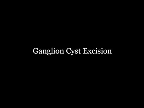Ganglion Cyst Excision