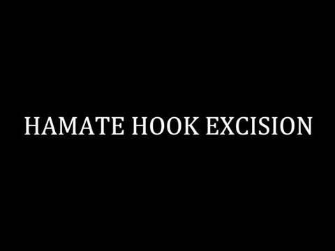 Hamate Hook Excision