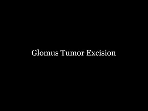 Glomus Tumor Excision