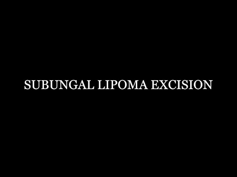 Subungal Lipoma Excision