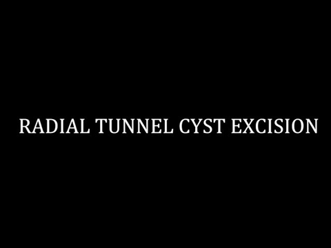 Radial Tunnel Cyst Excision