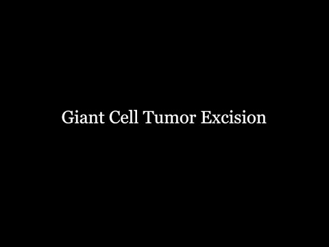 Giant Cell Tumor Excision