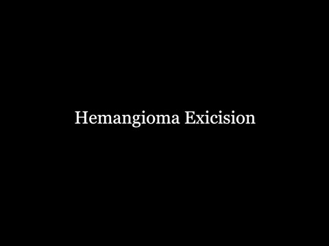 Hemangioma Excision