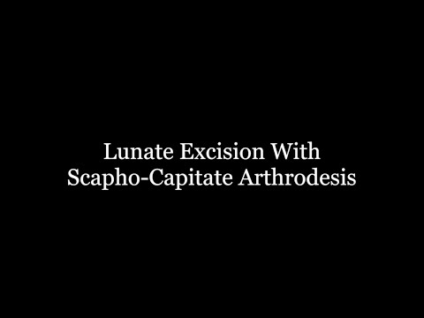 Lunate Excision With Scapho-Capitate Arthrodesis