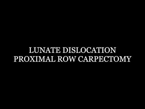 Lunate Dislocation Proximal Row Carpectomy