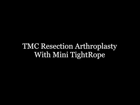 TMC Resection Arthroplasty With Mini TightRope
