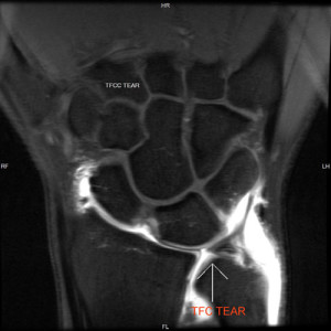 xray showing ligament tear