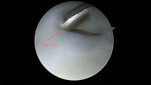picture of arthroscopic surgery to repair triangular fibrocartilage tear