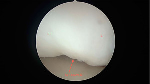 picture from arthroscopic surgery of ligament tear