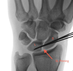 x ray of SL pinning for ligament tear