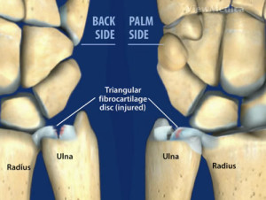 illustration showing injured triangular fibrocartilage disc