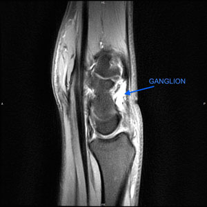 x ray showing ganglion cyst