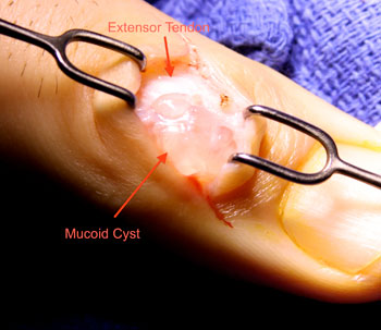 surgical photo showing inside of ganglion cyst on finger 