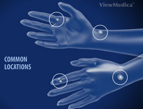 illustration of two hands showing common locations for ganglion cysts
