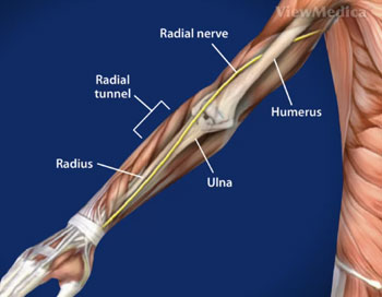 Tunnel syndrome radial What is