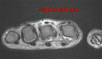 sagittal-band-tear-diagnosis