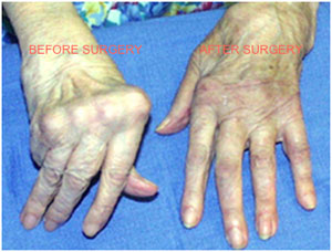Heberden s Nodes Surgery Before And After